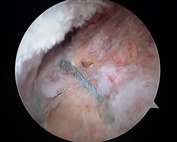 Endoscopic Abductor Tendon Repair